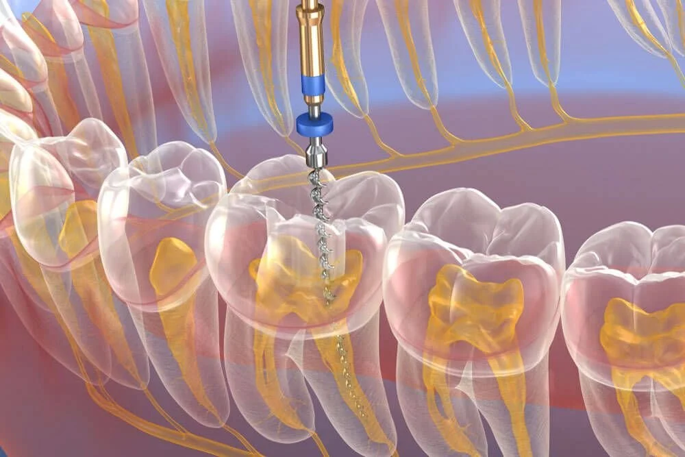 AI in Endodontics: Precision and Efficiency