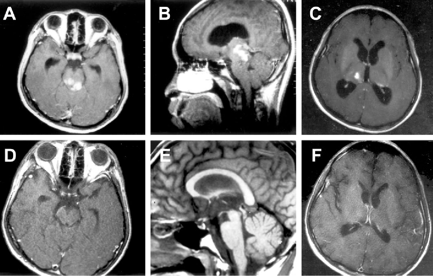 Unlikely Neuropsychological Explanations for Musical Agnosia