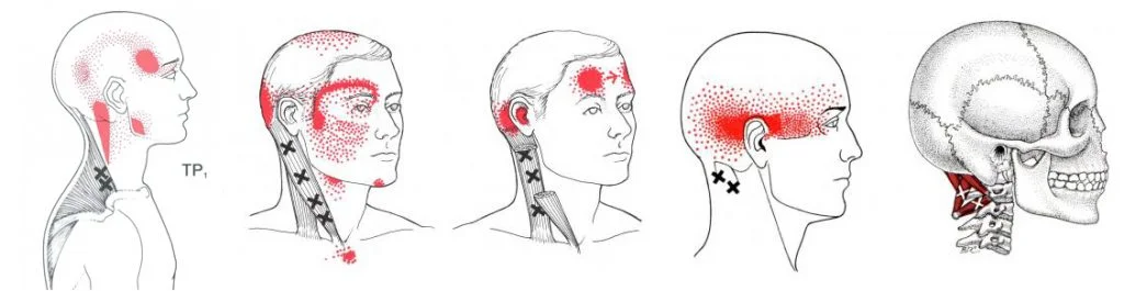 OSTEOPATIA E CEFALEE