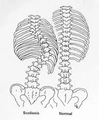 OSTEOPATIA E SCOLIOSI