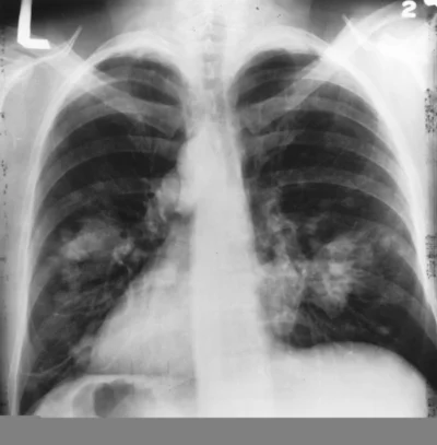 X-ray(Chest)Cancer.jpg