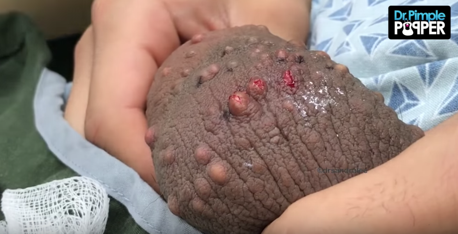 9. Lee, Sandra, director. Removing Calcinosis Cutis: Pt.1 YouTube, 9 Jan 2018, https://www.youtube.com/watch?v=noZtiLf8RB8.