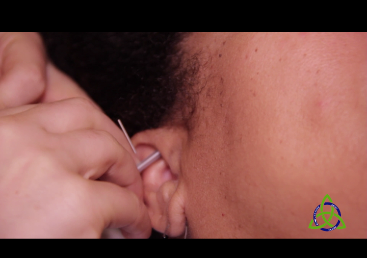 Auricular Acupuncture