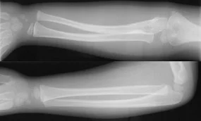 bowing-fracture.jpg