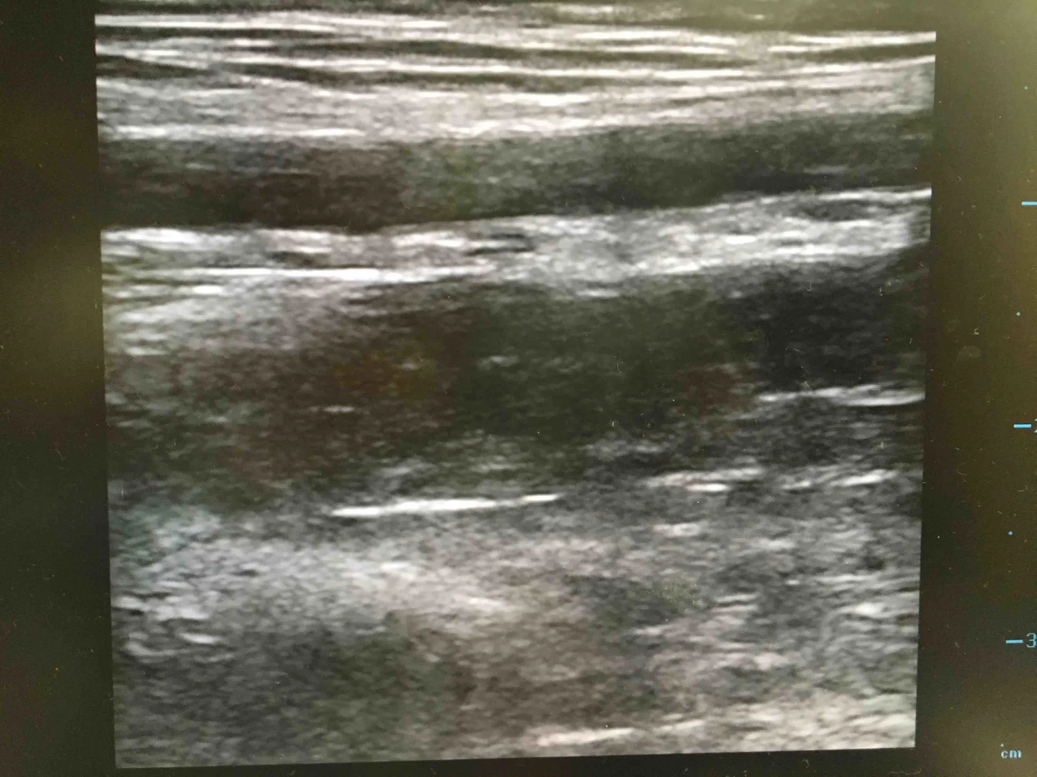 Visualize the Vessel: Jonas Pologe's Guide to US-Guided PIV Placement ...