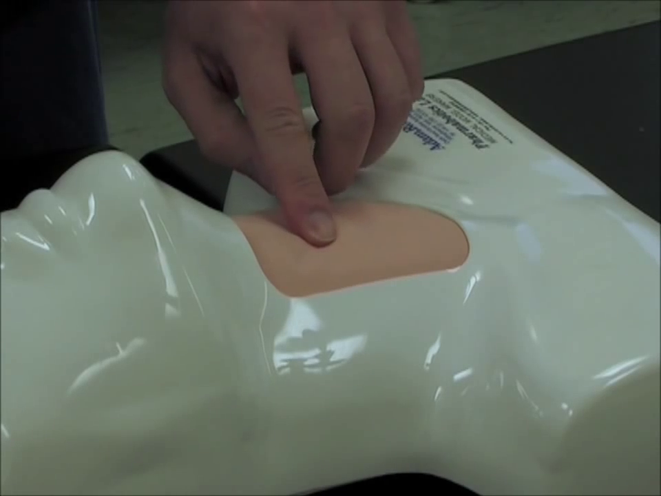 Transcricothyroid Injection Needle Cricothyroidotomy and Transtracheal Catheter Ventilation ...
