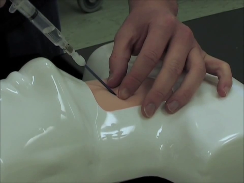Transcricothyroid Injection Needle Cricothyroidotomy and Transtracheal Catheter Ventilation ...