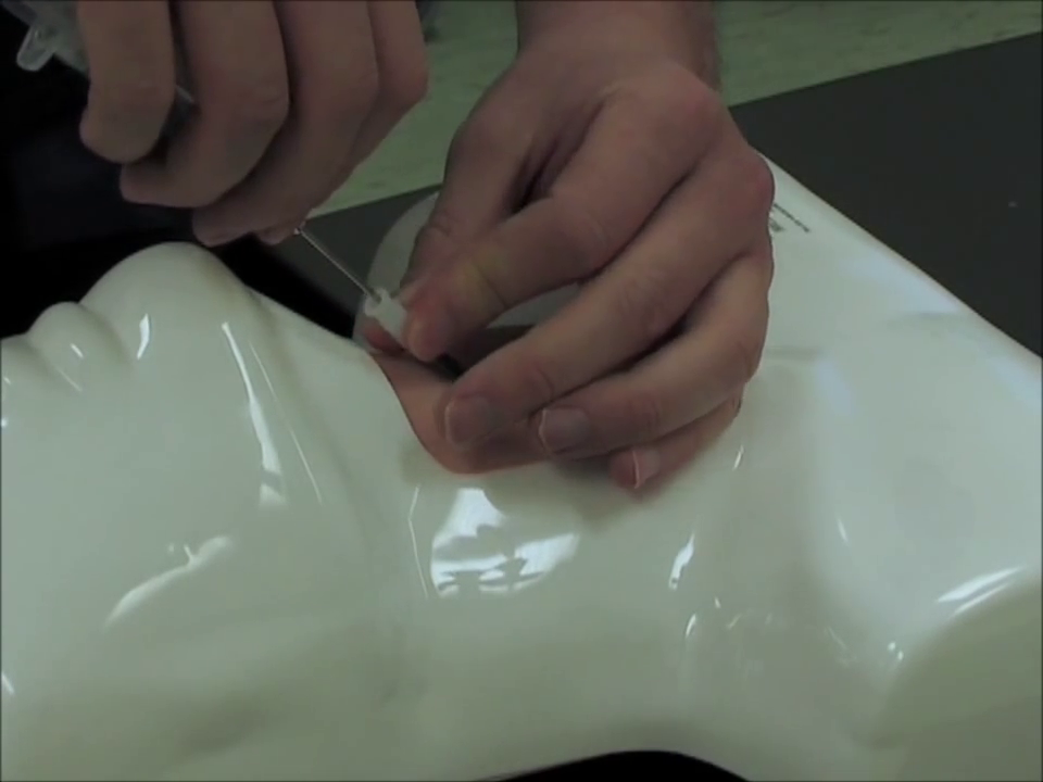 Transcricothyroid Injection Needle Cricothyroidotomy and Transtracheal Catheter Ventilation ...