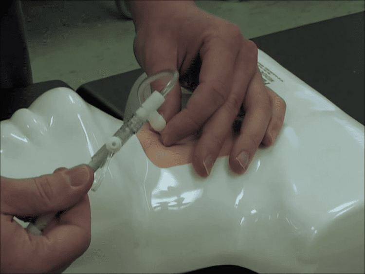 Needle Cricothyroidotomy and Transtracheal Catheter Ventilation ...
