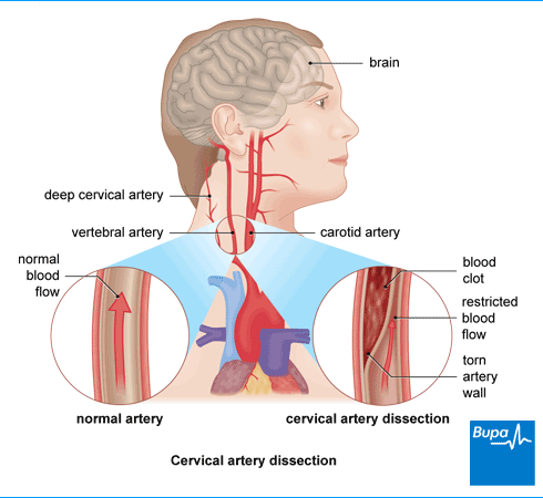 cervical-artery-dissection.png