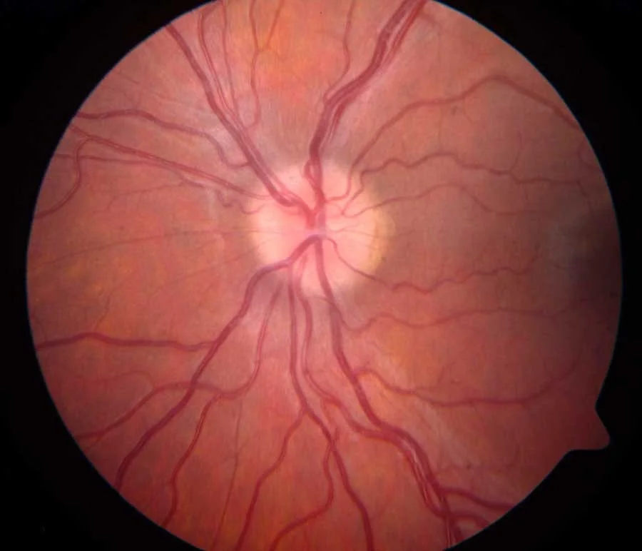 potd eye papill.jpg