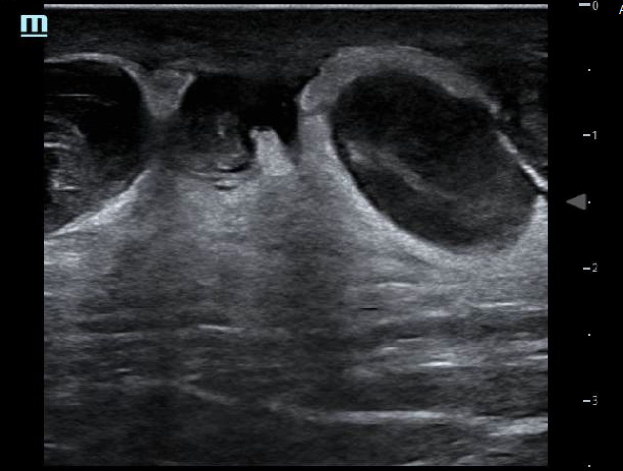 thrombophlebitis.png