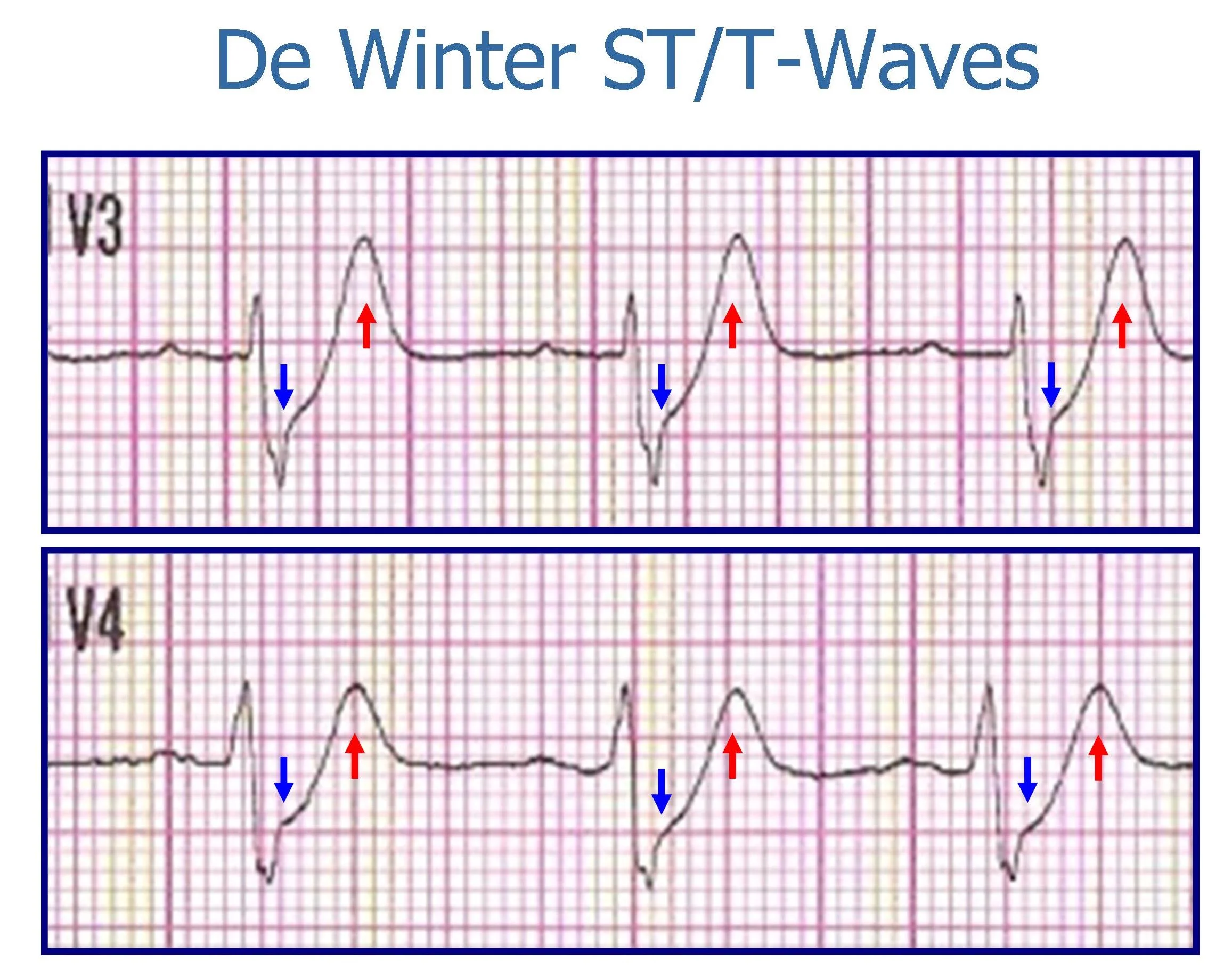 POTD stemi equivalents when to call the cath lab — Maimonides