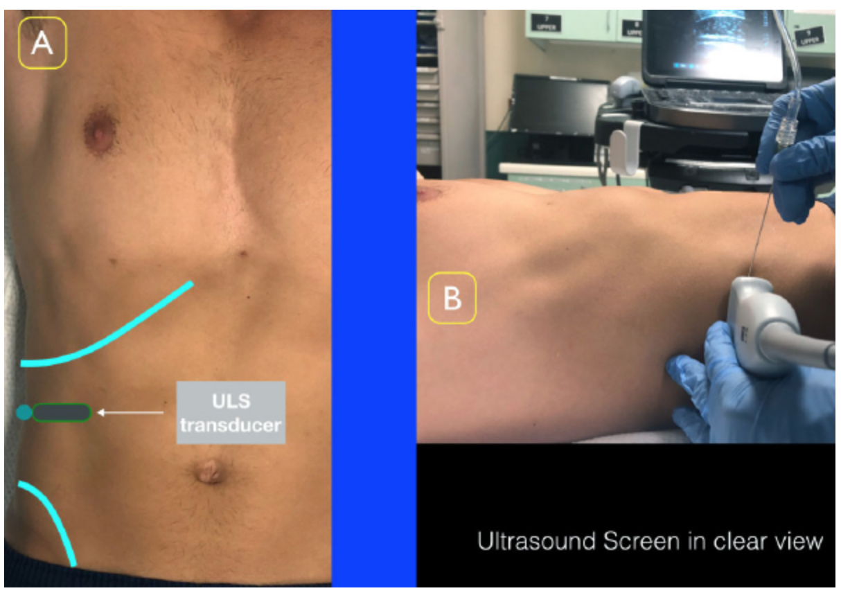 Figure 2: Place the ultrasound transducer between the inferior costal margin and iliac crest. The probe marker should point lateral/posterior.