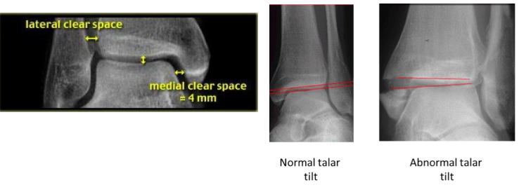 Ankle Fractures Maimonides Emergency Medicine Residency Ankle Fractures Maimonides Emergency Medicine Residency