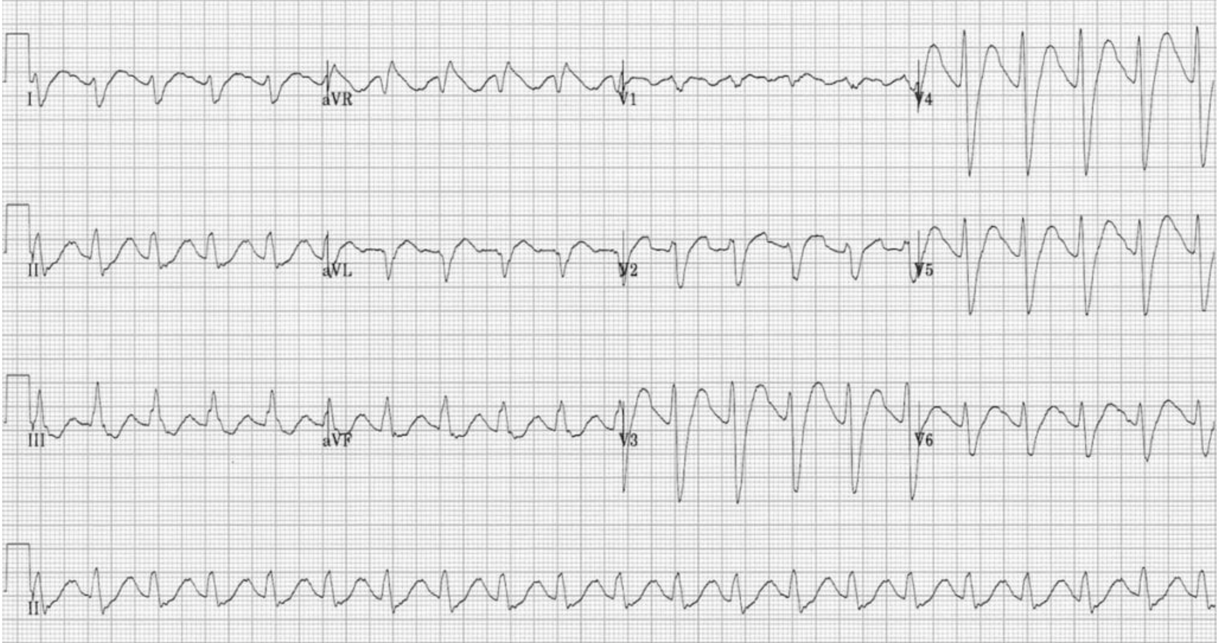1. Rate, rhythm, axis, intervals – you can glean a lot of information from these pieces alone 2. What’s the suspected overdose? 3. Treatment?