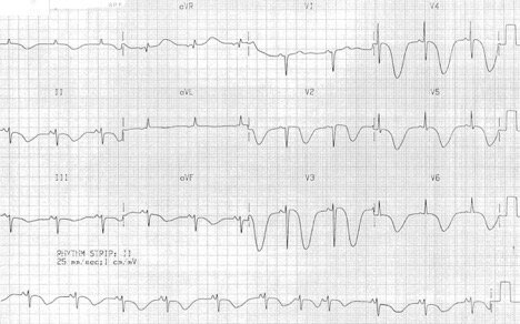 1. Which came first, the EKG or the fall?