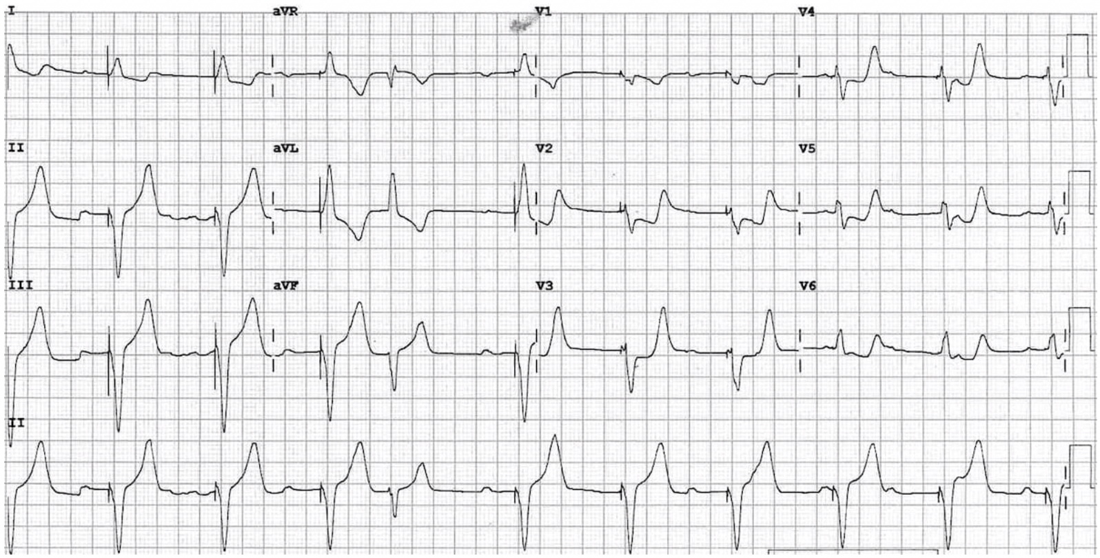EKG — Blog — Maimonides Emergency Medicine Residency