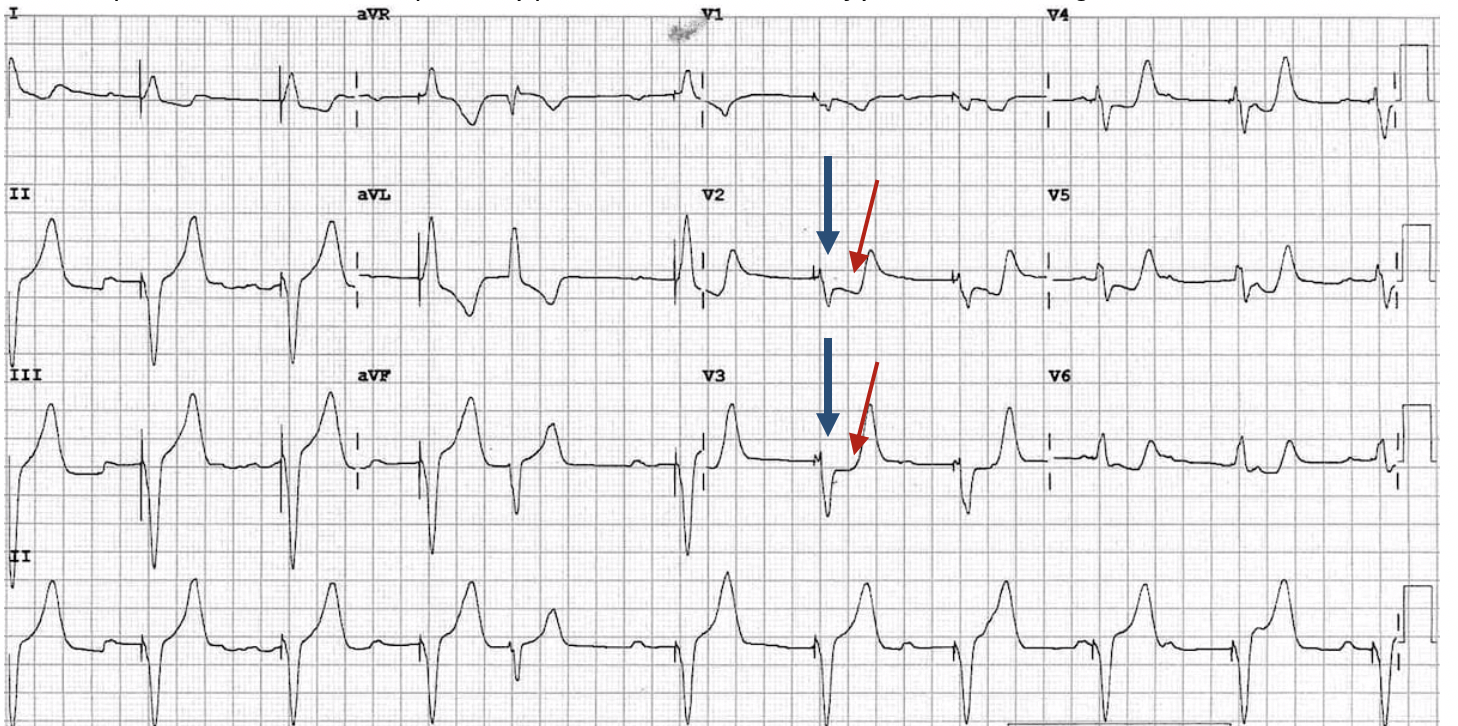 EKG — Blog — Maimonides Emergency Medicine Residency