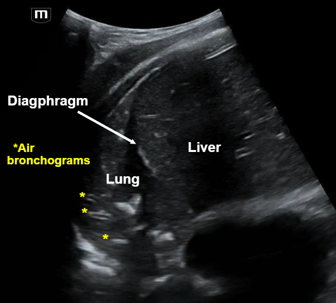 VOTW: What did the lung say to the liver? We be-lung together ...