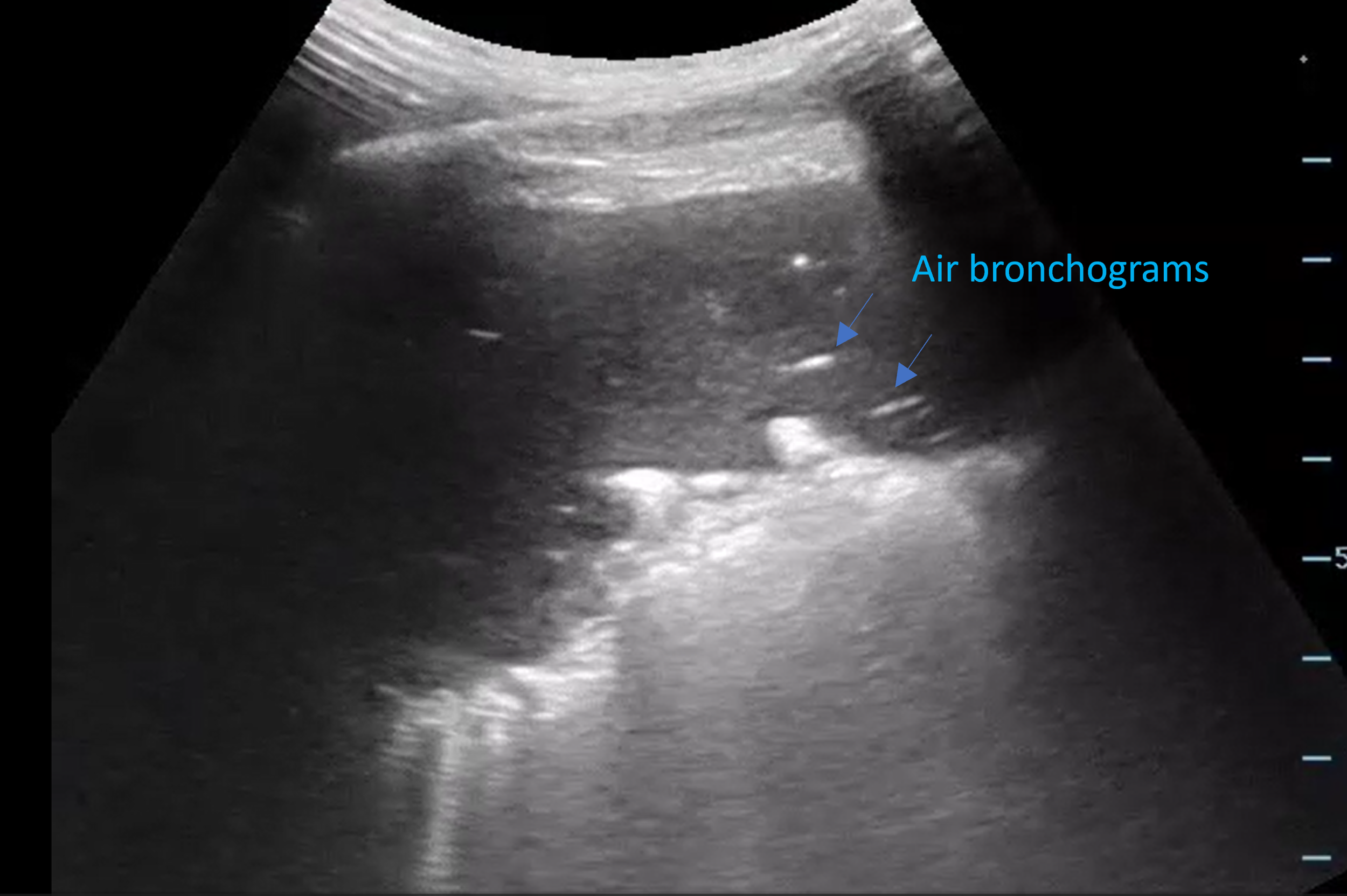 VOTW: Hepatization of Lung — Maimonides Emergency Medicine Residency