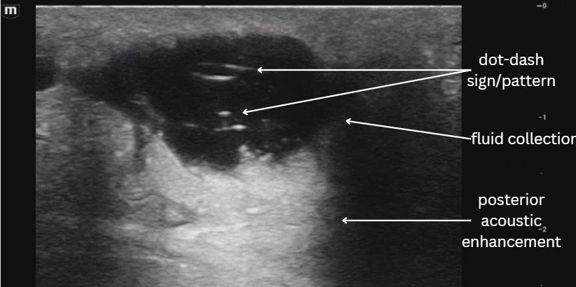 Dash Radiology VOTW: A Hairy Situation — Maimonides Emergency Medicine Residency