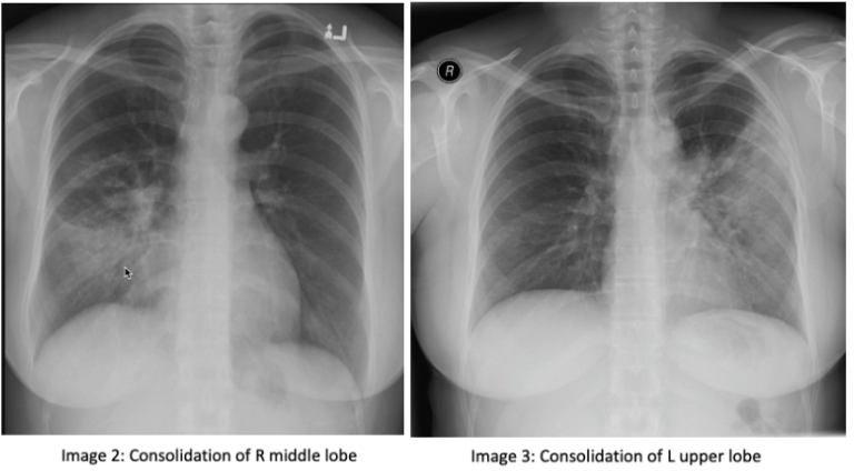 CXR- Consolidation or Atelectasis? — Maimonides Emergency Medicine ...