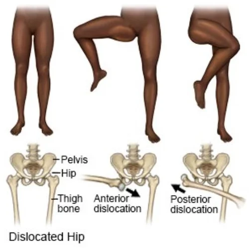 POTD: Those Hips Don't Lie — Maimonides Emergency Medicine Residency