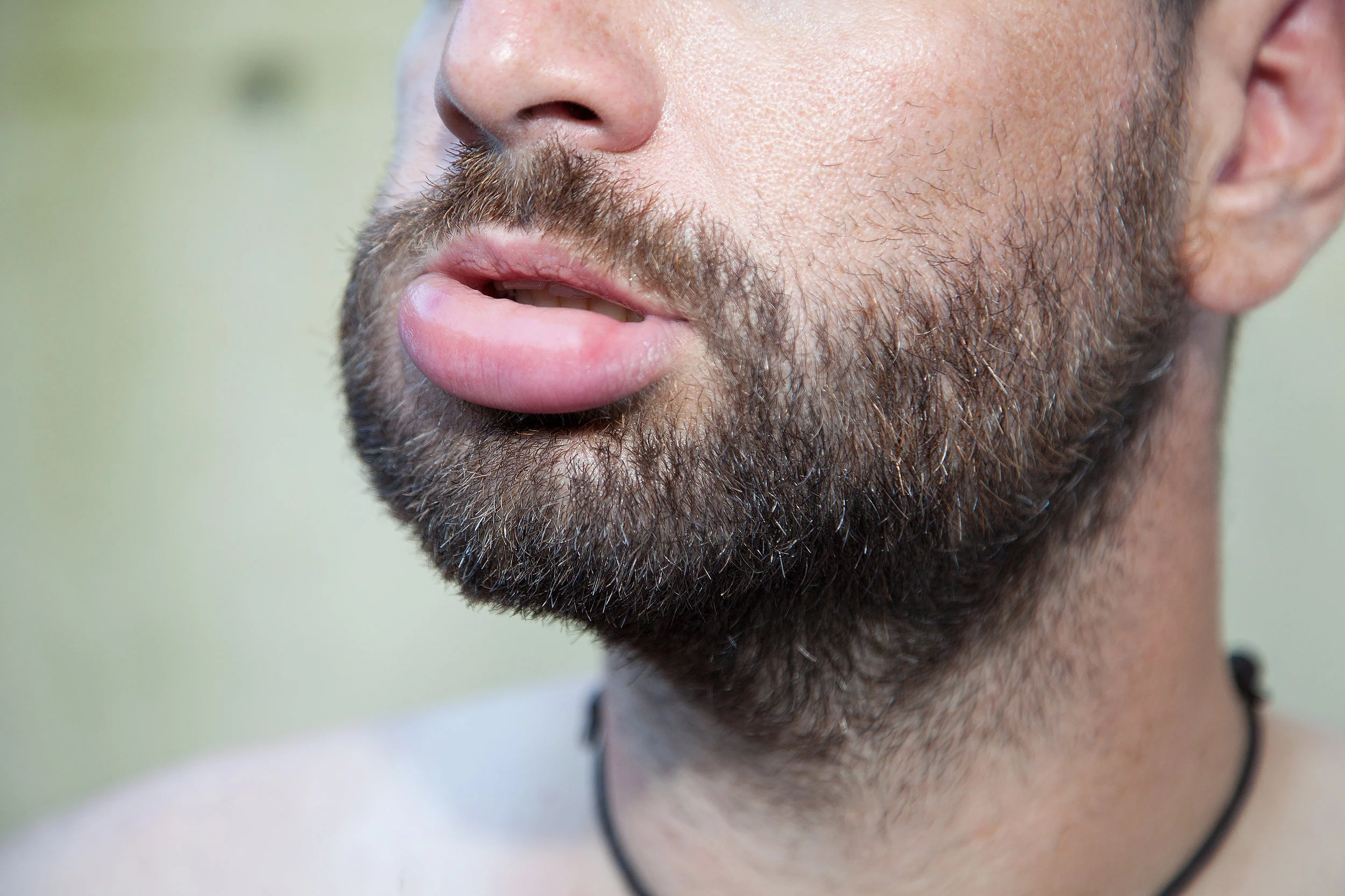 symptoms of bee allergies.jpg