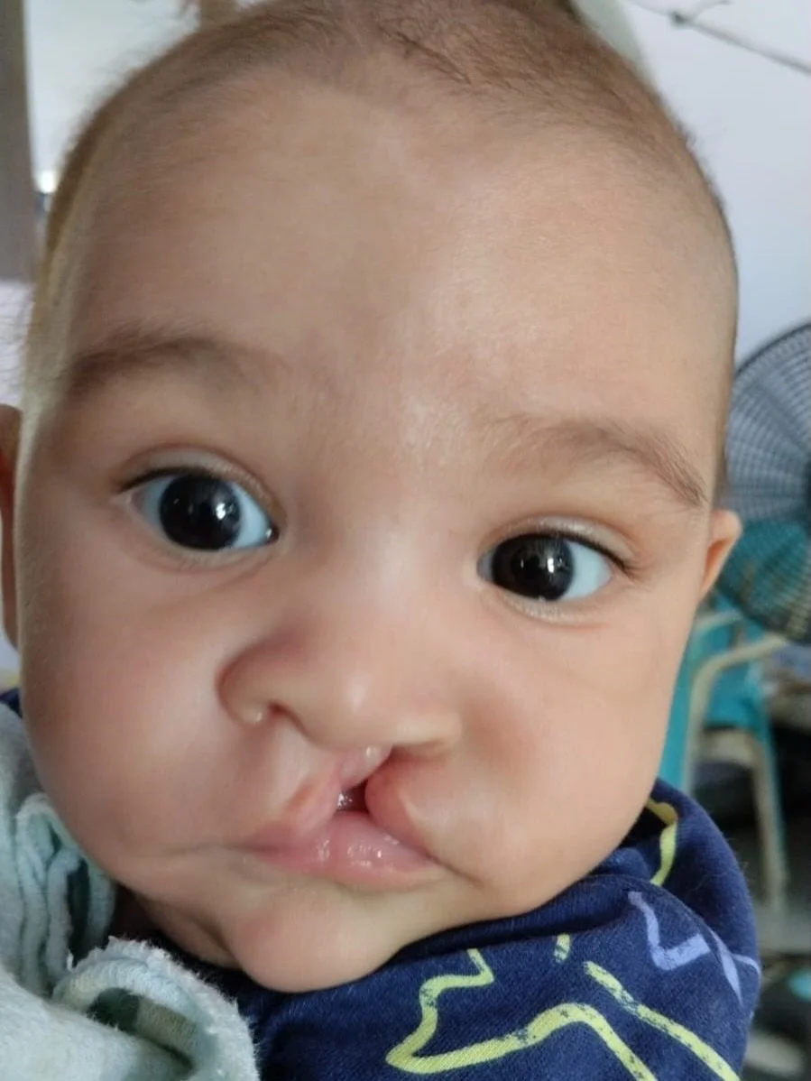 💙 One gift. One surgery. One life forever changed.

Today, our hearts are filled with gratitude as we thank the Rotary Club of New York Queens for their generous $675 donation, which made it possible for Salvador Losano, a beautiful 4-month-old baby