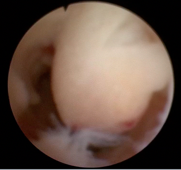 Endometrial polyps.png