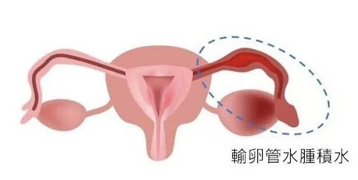 輸卵管水腫造成不孕怎麼解?
