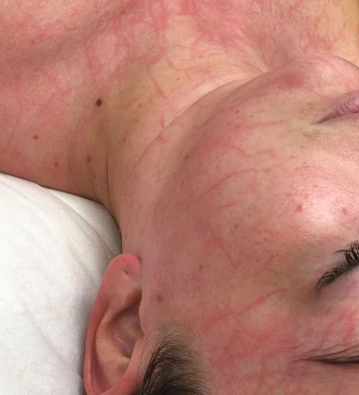 The PRIN effect. We are the only clinic in New Zealand to offer the PRIN Lymphatic Enzyme therapy treatment.