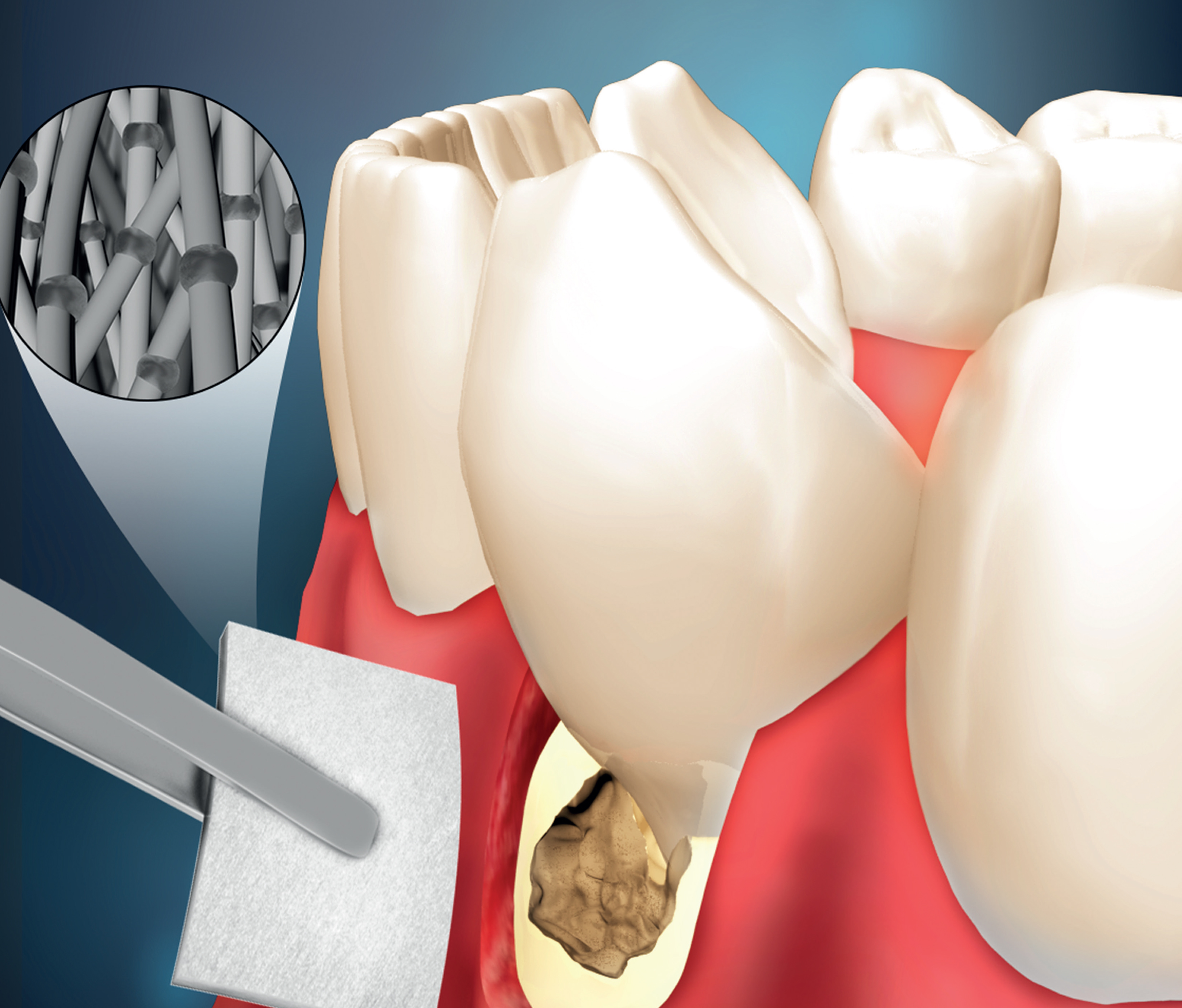 A novel multifunctional membrane for periodontal tissue engineering. Moshaverinia Lab