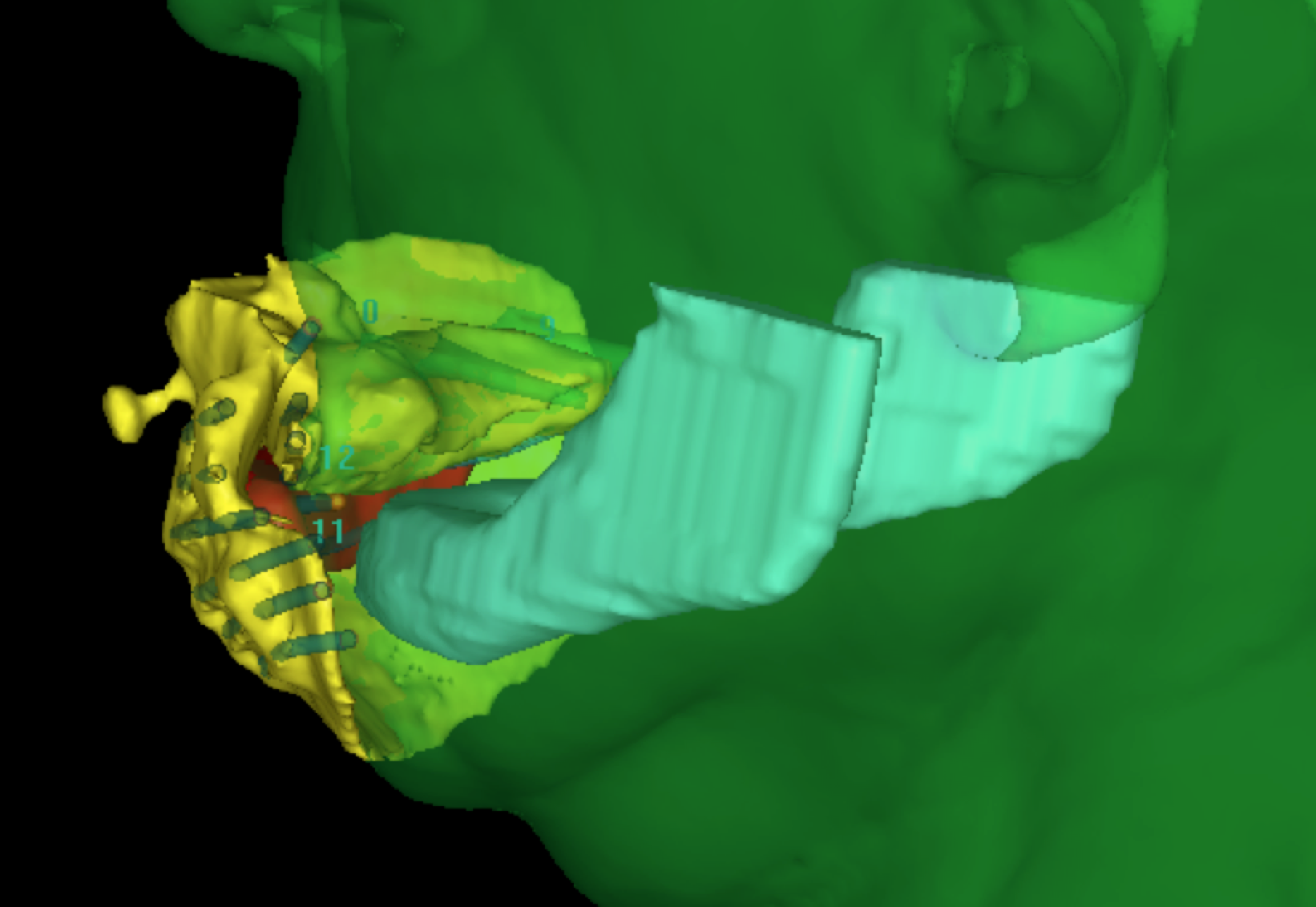 Collaboration with Head and Neck Radiation Oncology, Brachytherapy. Prosthetic applicator for surface delivery of radiotherapy. 