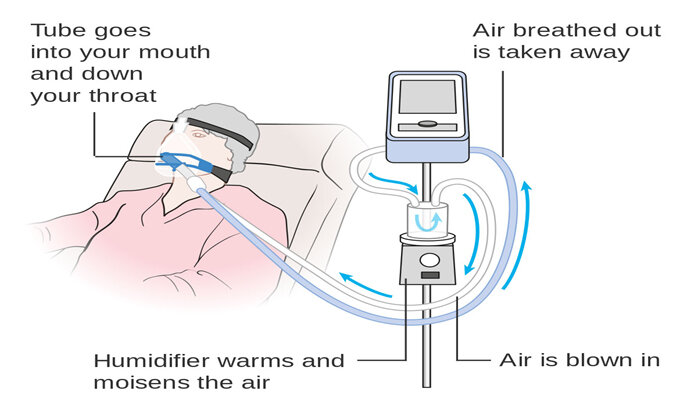 Ventilator splitting and monitoring — Prosthodontics, Special