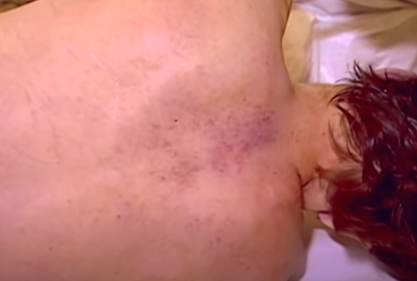 The bruising on Jesse’s back resulting from the chokehold he was placed in (source: youtube.com)