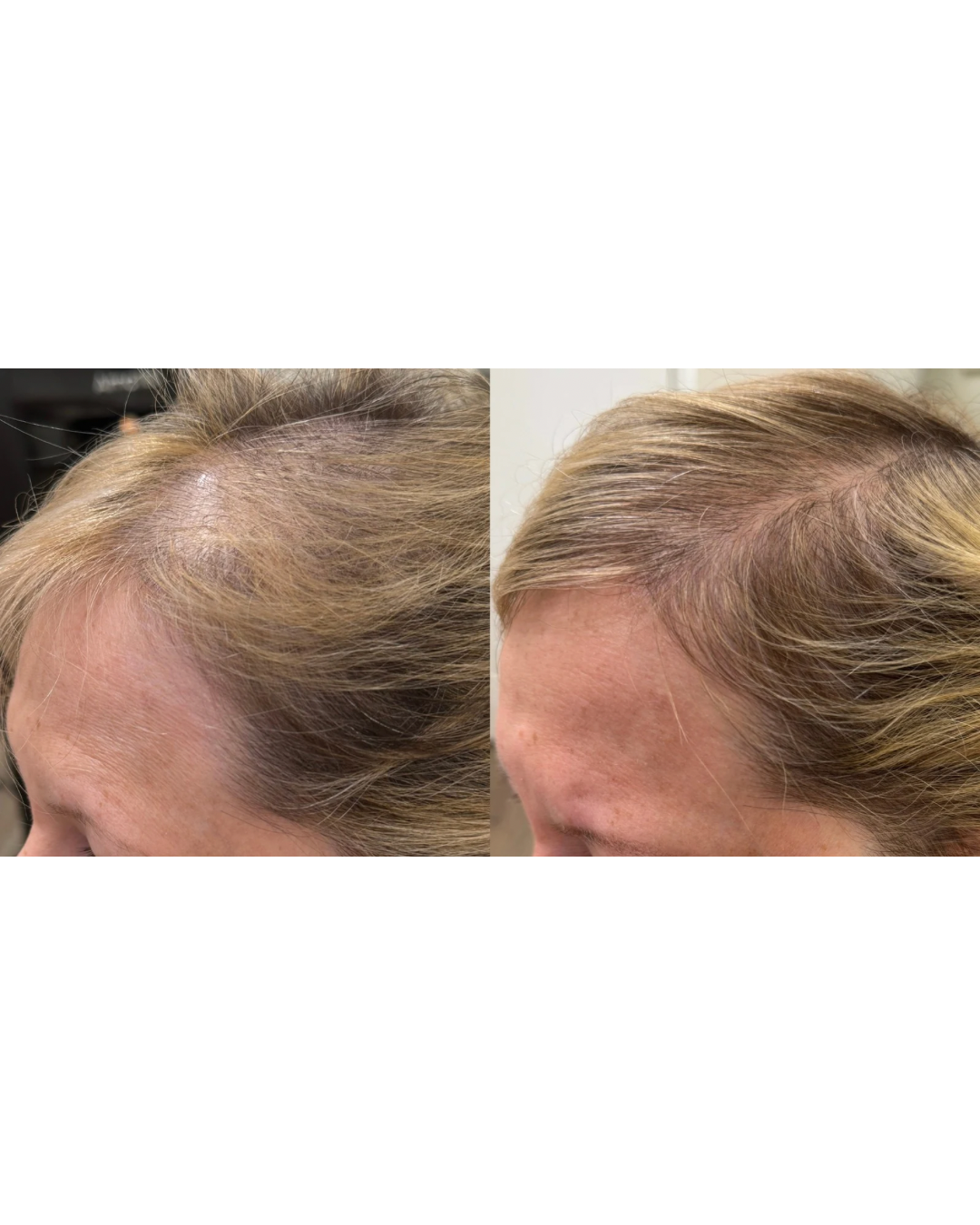 Before and after images of a woman's scalp showing improved hair density after treatment.