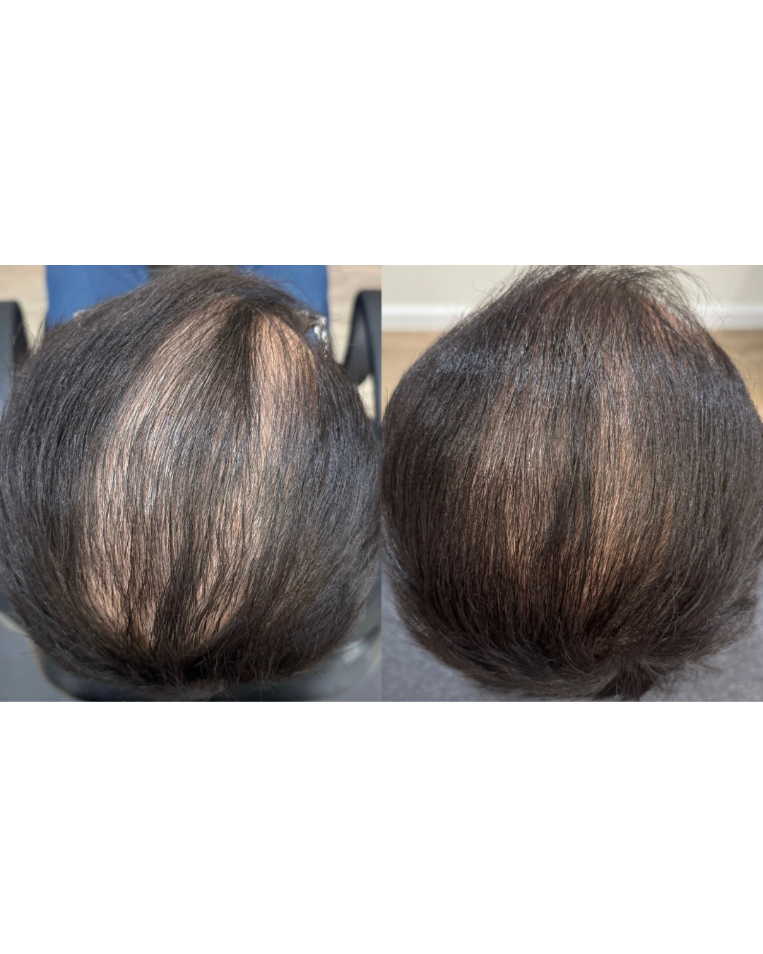 Comparison of before and after images showing improved hair density and coverage on the top of a person's head.