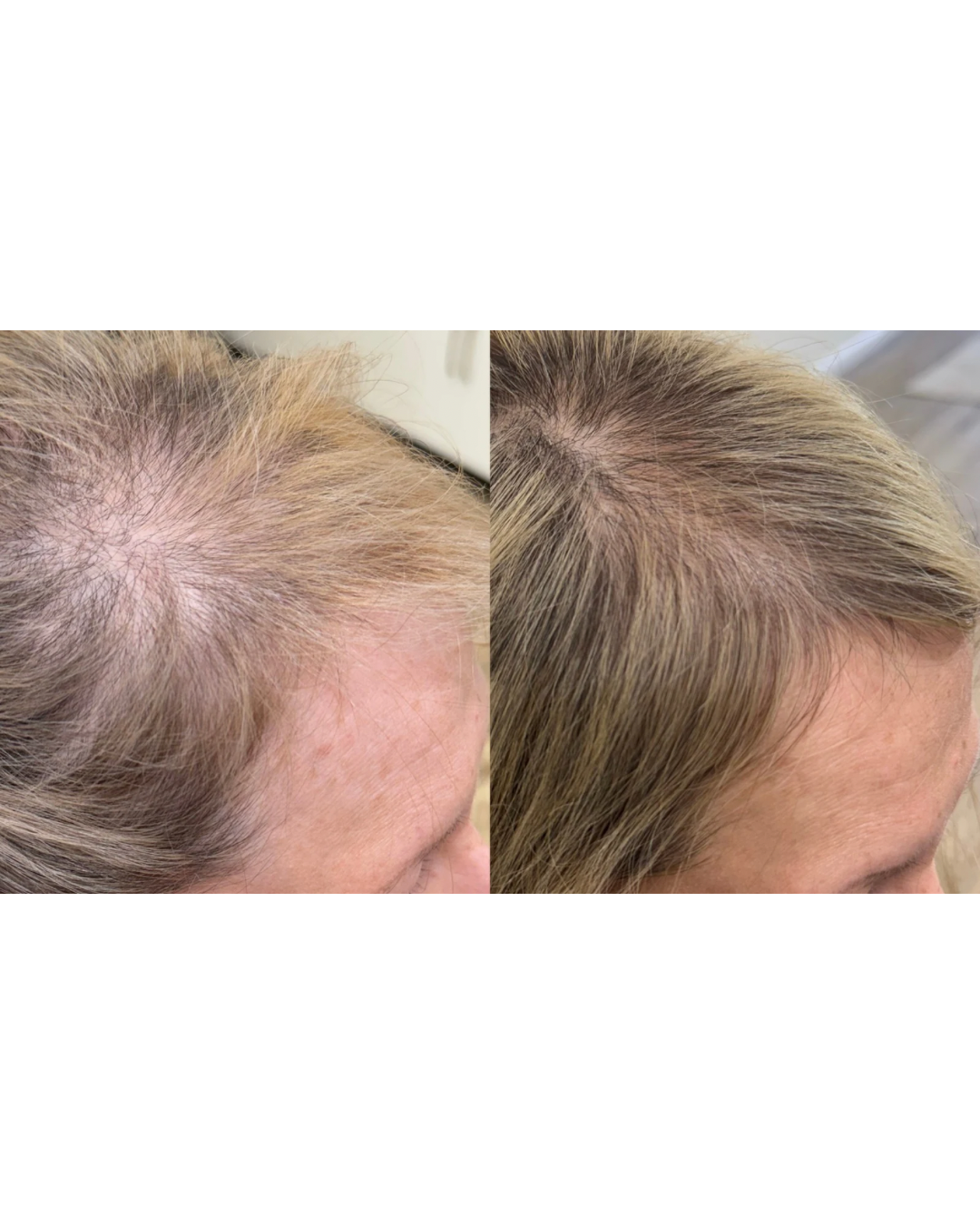 Before and after images showing improvement in hair density and color on a woman's scalp.