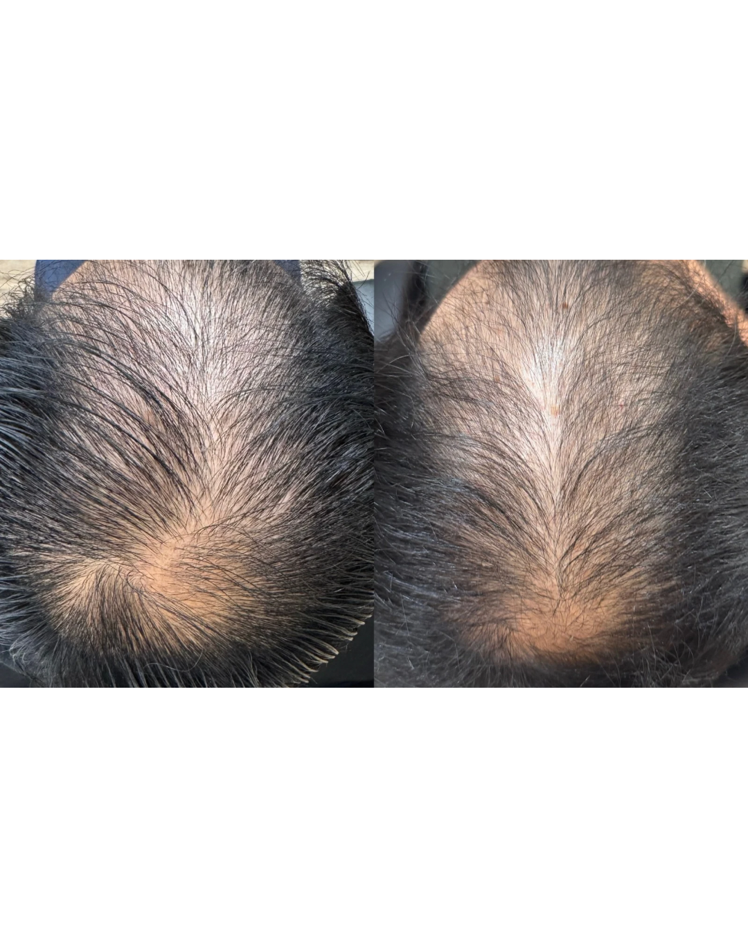 Comparison of scalp before and after hair treatment showing increased hair density.