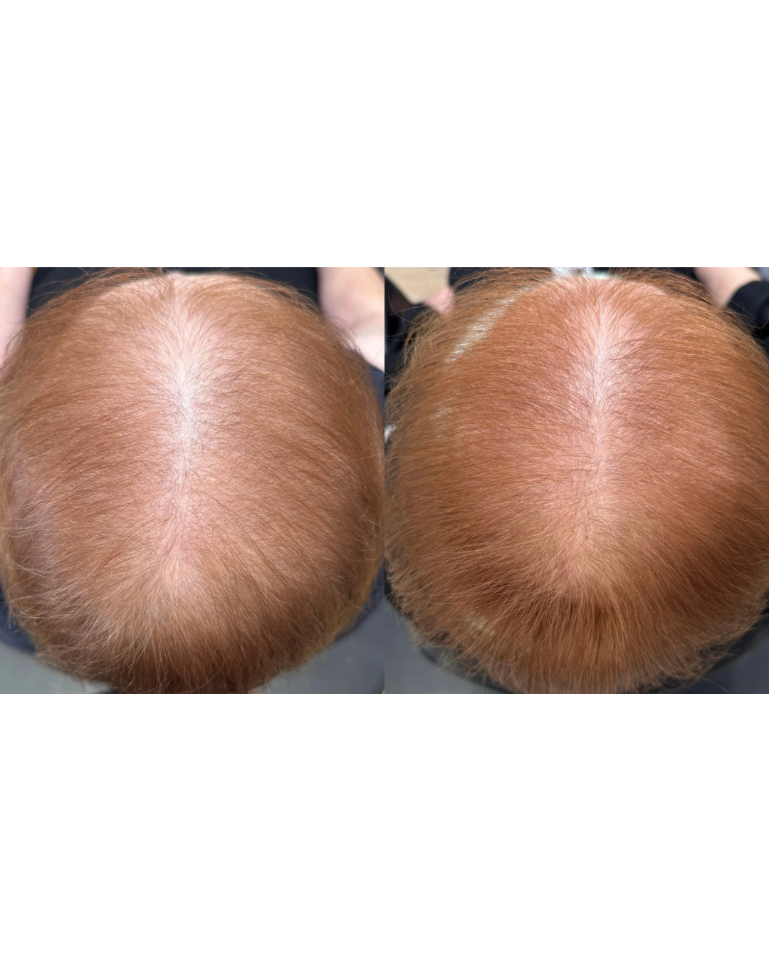 Comparison of the top of a person's head before and after hair treatment, showing improved hair density and color.