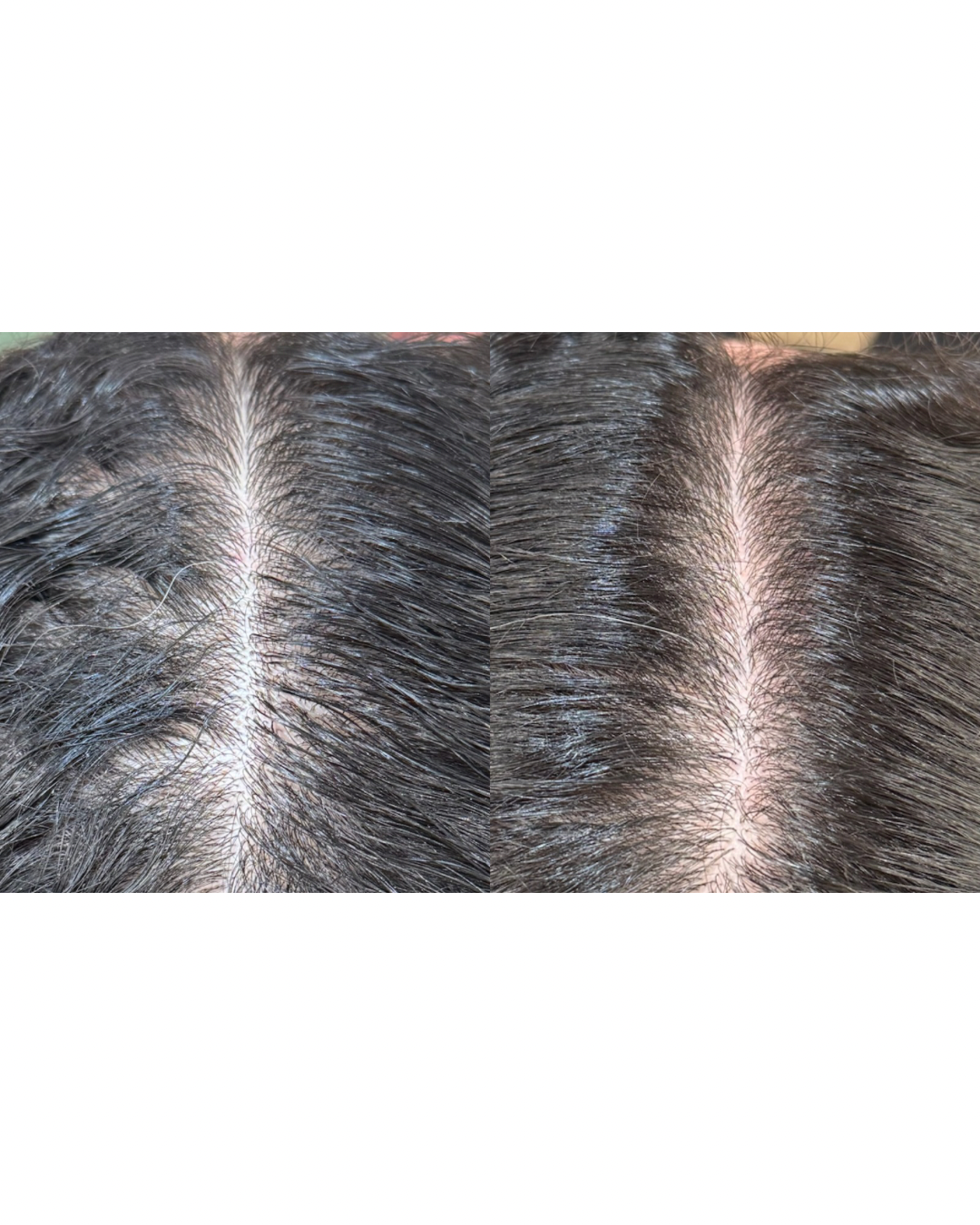 Comparison of a person's scalp before and after hair treatment, showing increased hair density and improved scalp coverage.