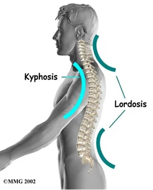 kyphosis.jpg