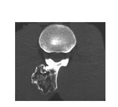 osteochondroma.jpg