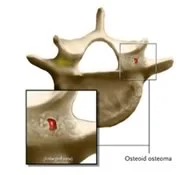 osteoid.jpg