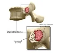 Osteoblastoma_.jpg