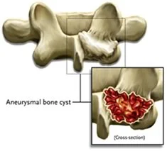 Aneurysmal_Bone_Cysts_.jpg