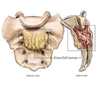 _Giant_Cell_Tumor_.jpg