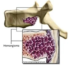 Hemangioma.jpg
